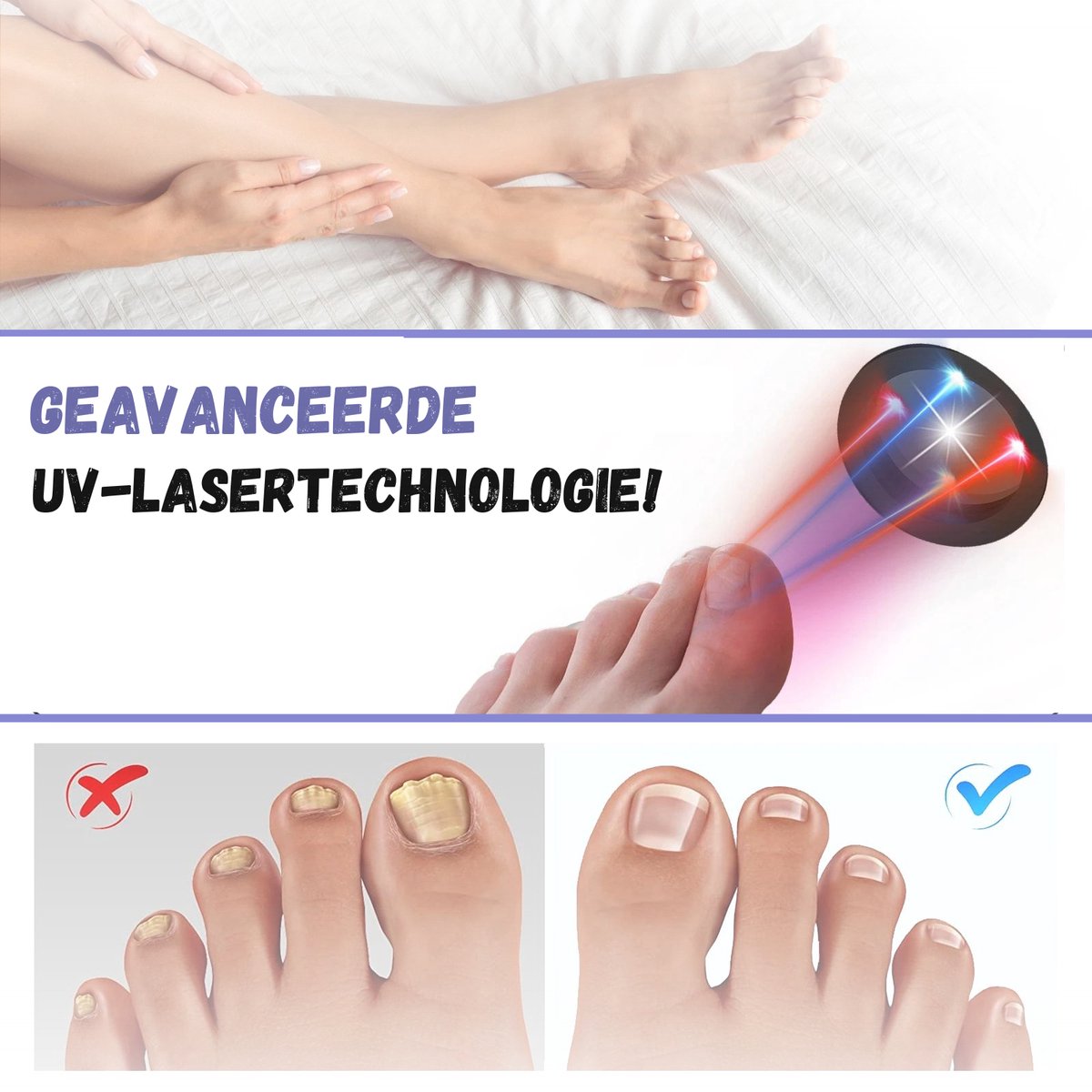 Schimmelnagel Behandeling - Kalknagelbehandeling - 2-in-1 - Kalknagelproducten - Laser - Zwart