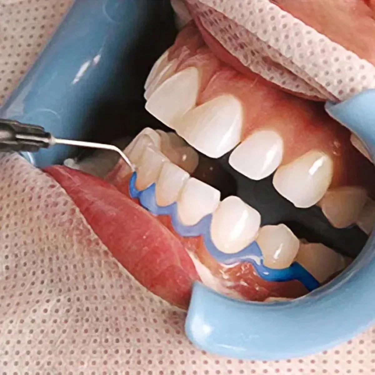 3 ML Gum Protector - 10 Stuks - voor het bleken van tanden