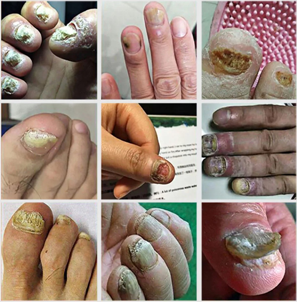 Schimmel Nagellaserapparaat Nagels Schimmel Snelle Reparatie Gezonde Teennagels Vingernagels Verwijdert Nagelschimmel Voetverzorging Kuur Ingegroeide Anti Nagel Schimmel