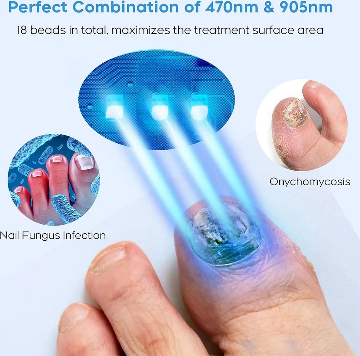 Schimmel Nagellaserapparaat Nagels Schimmel Snelle Reparatie Gezonde Teennagels Vingernagels Verwijdert Nagelschimmel Voetverzorging Kuur Ingegroeide Anti Nagel Schimmel