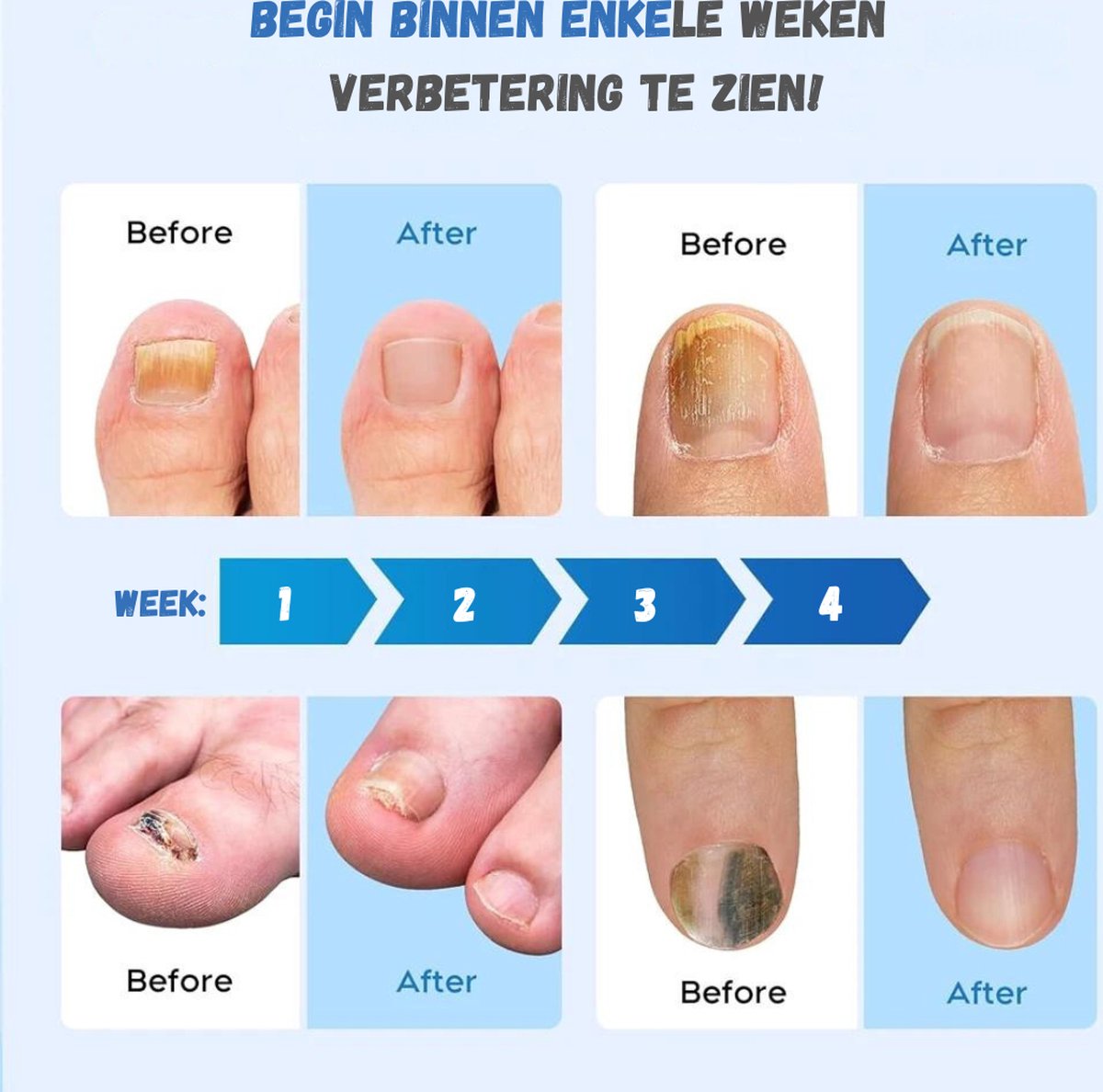 Toenail Fungus Treatment - 5-IN-1 - Nail Fungus Treatment - Nail Fungus Products - Laser - Whole Foot - Wireless - White