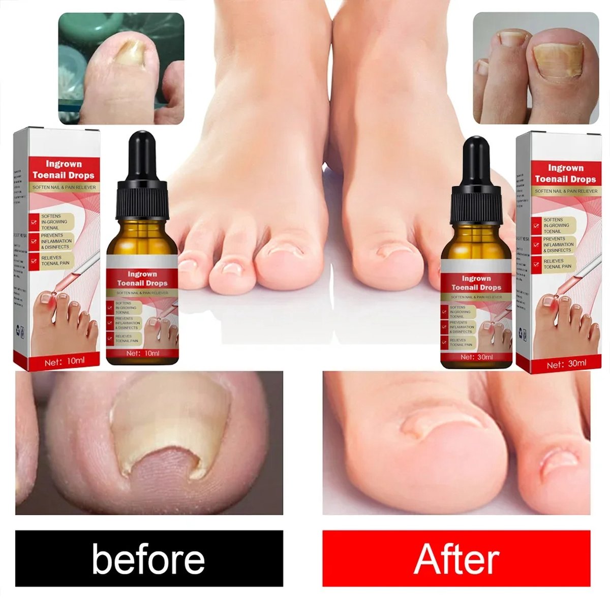 Schimmel Nagellaserapparaat Nagels Schimmel Snelle Reparatie Gezonde Teennagels Vingernagels Verwijdert Nagelschimmel Voetverzorging Kuur Ingegroeide Anti Nagel Schimmel